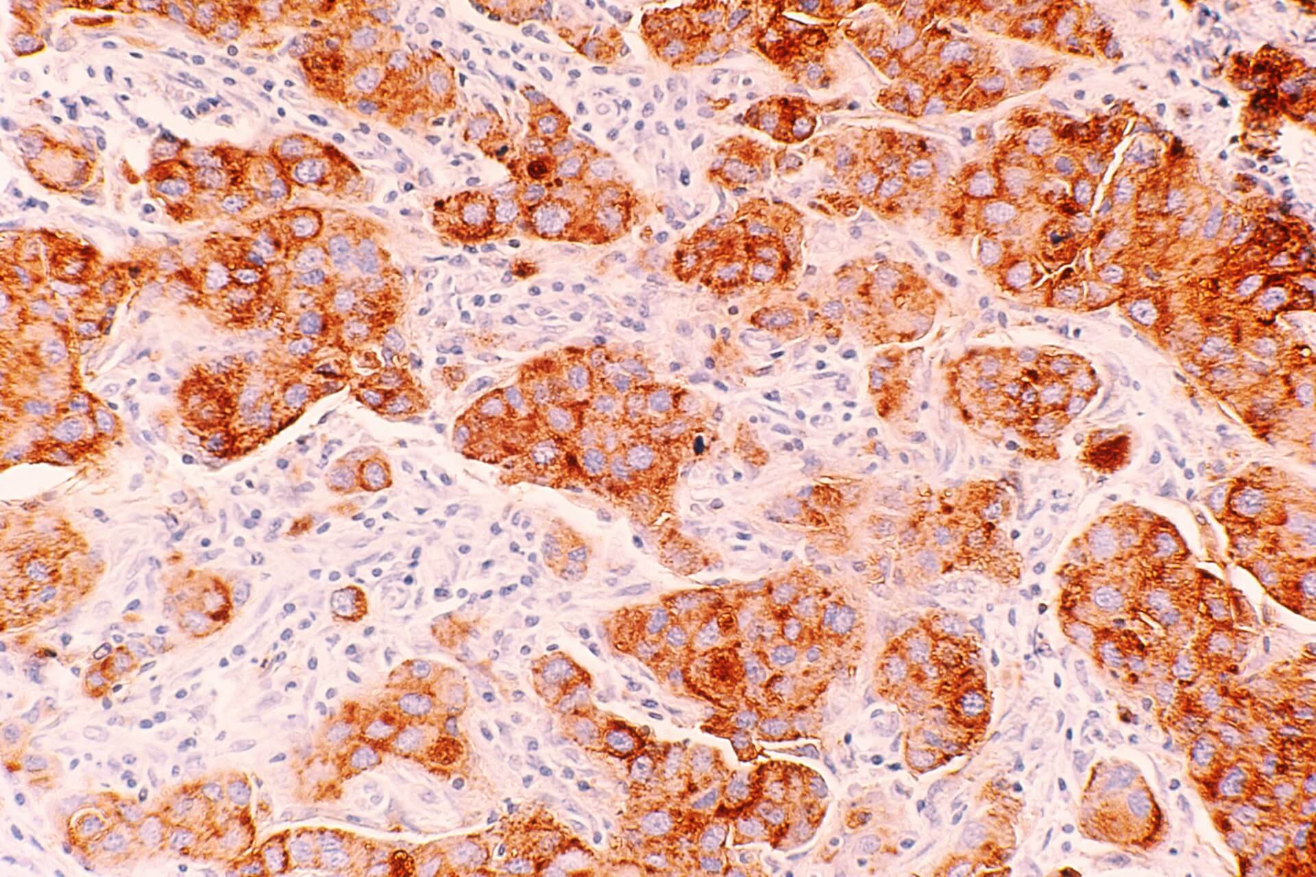 A microscopic view of Ductal Carcinoma.